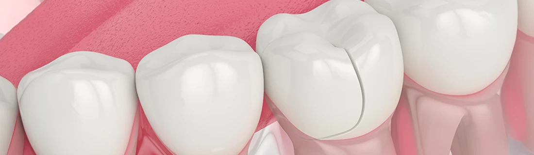 Cracked Teeth in Woodstock GA