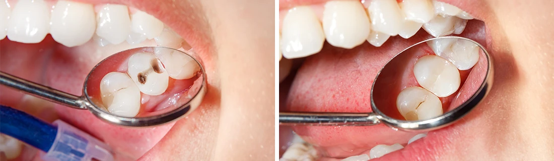 Dental Fillings in Woodstock GA