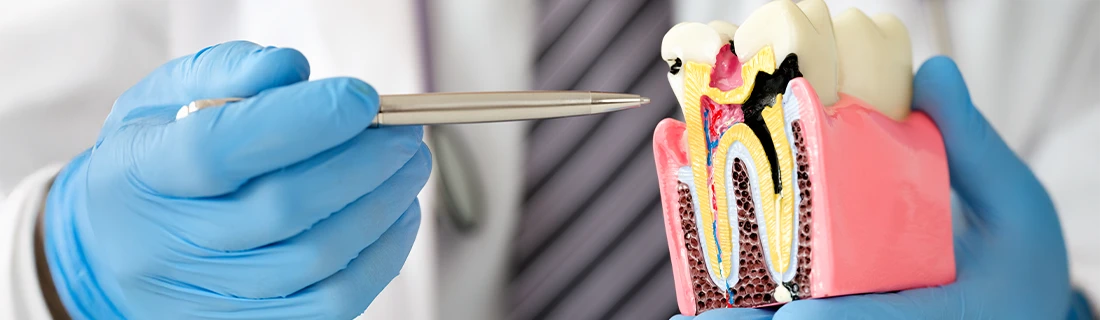 Root Canal Treatment in Woodstock GA