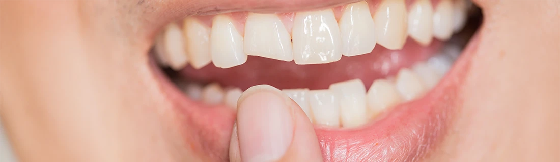 Broken Tooth in Woodstock GA