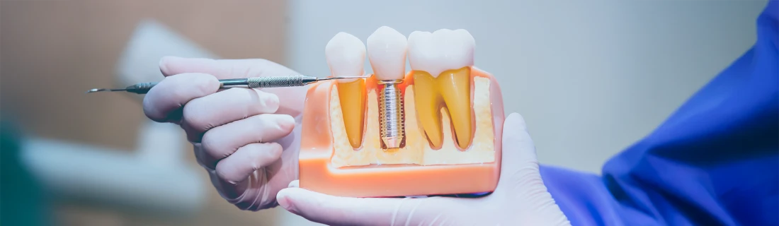 Dental Implants in Woodstock GA